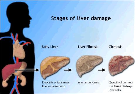 acute_hepatitis